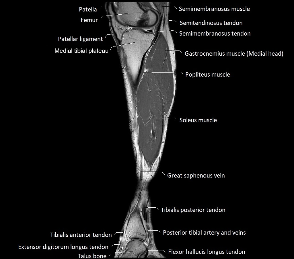 Lower leg sagittal anatomy 3T MRI image 22.webp
